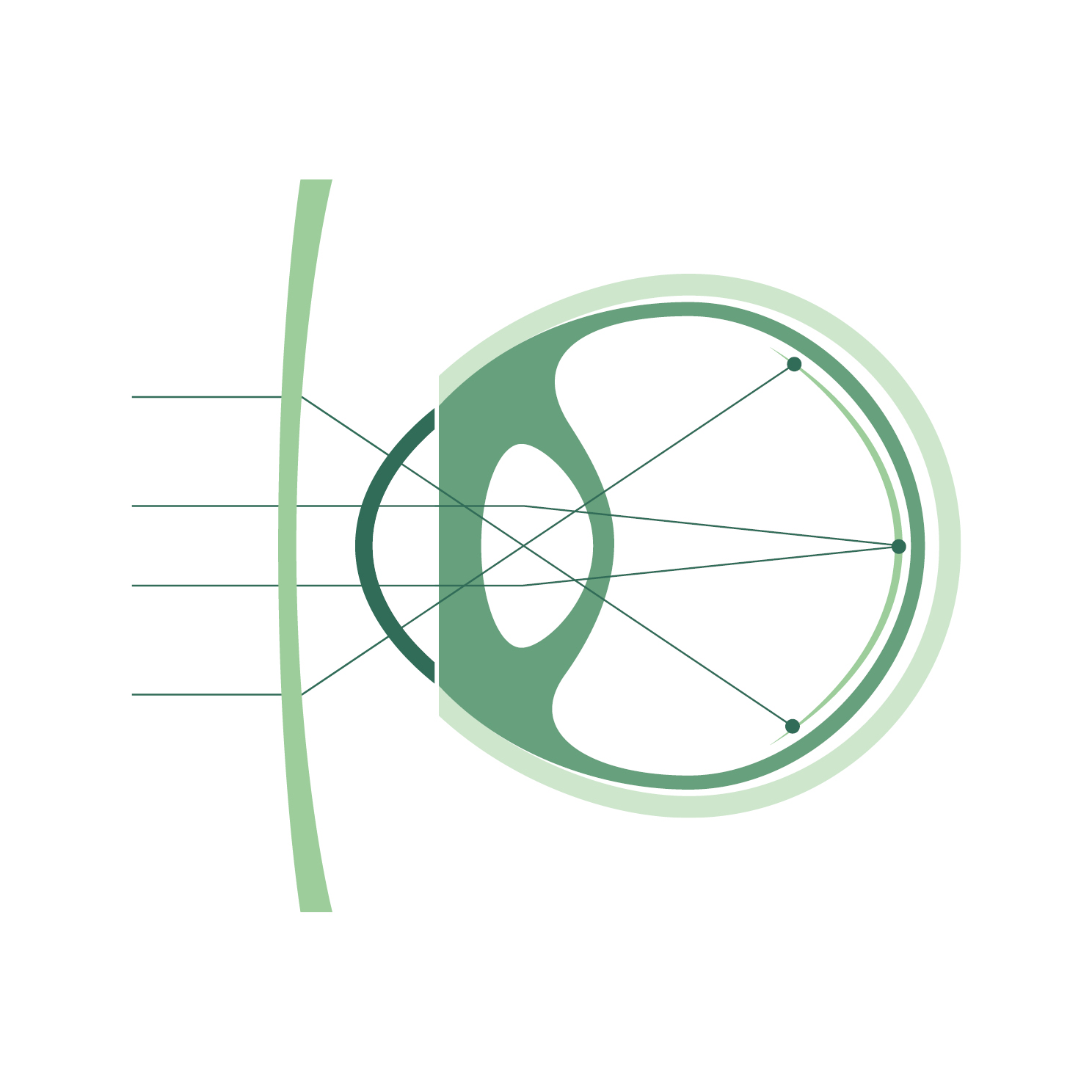 Kurzsichtiges Auge mit My-Kid
