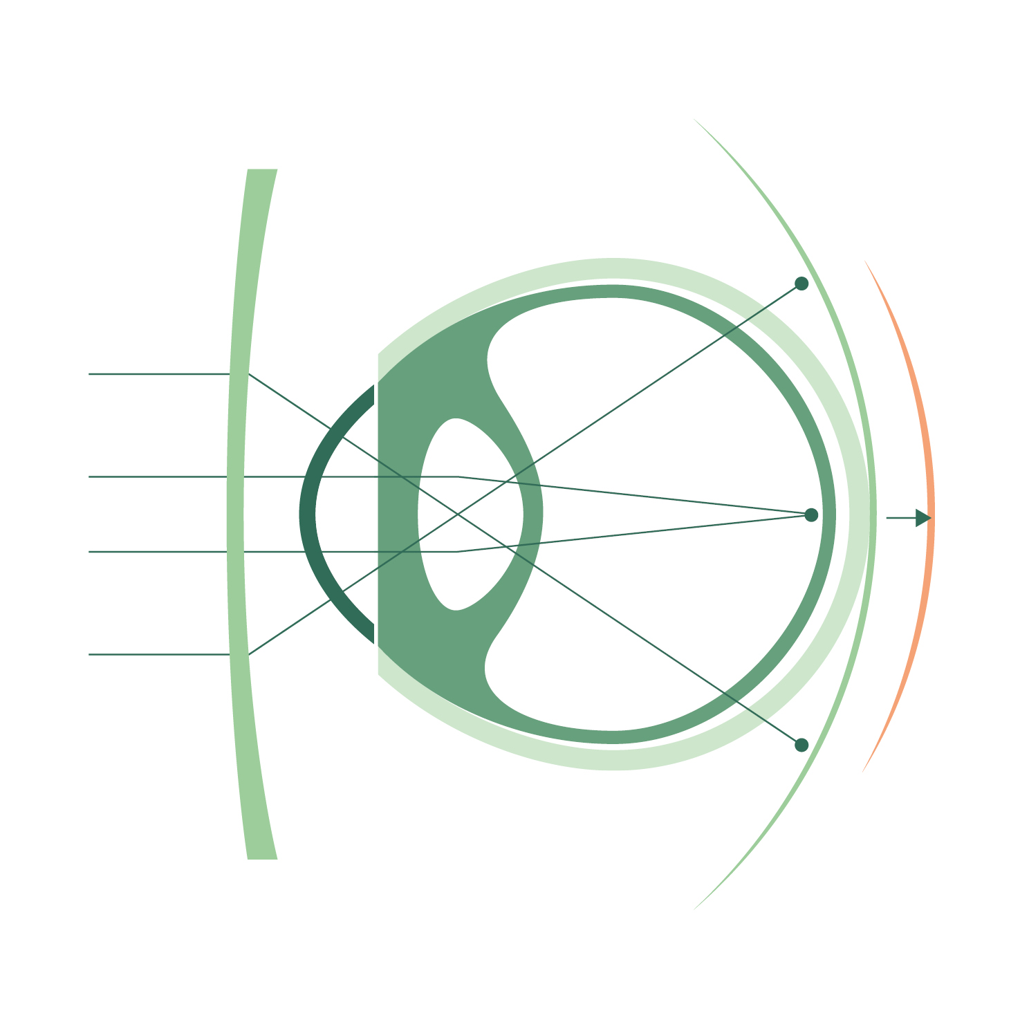Kurzsichtiges Auge mit Einstärkenglas
